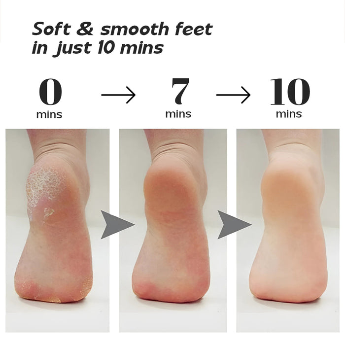 Electronic Callus Remover