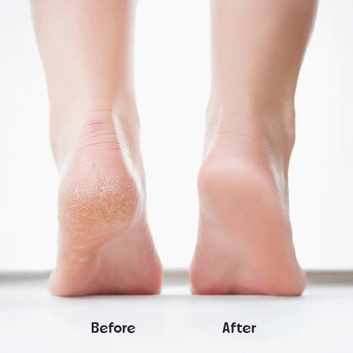 Electronic Callus Remover