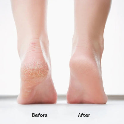 Electronic Callus Remover